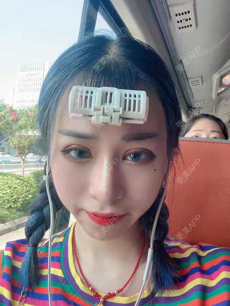 更美 - 饭冰冰儿的鼻部多项经验 | 鼻部多项 | 硅胶隆鼻 | 鹰钩鼻矫正 | 肋软骨隆鼻 | 鼻翼缩小