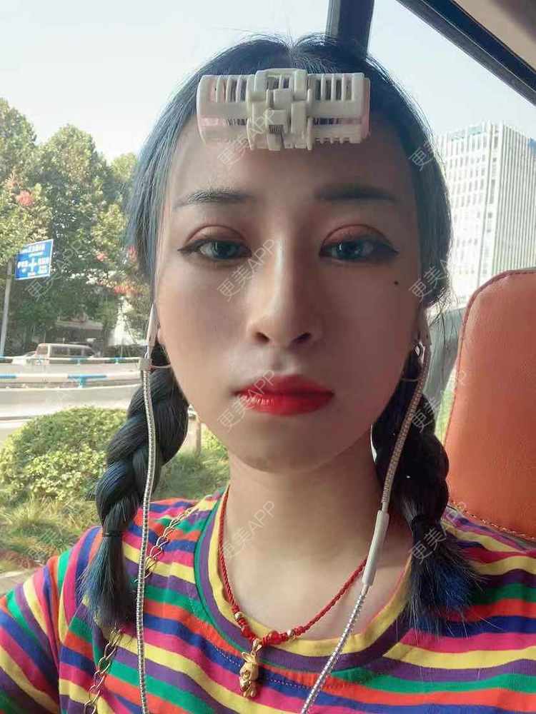 更美 - 饭冰冰儿的鼻部多项经验 | 鼻部多项 | 硅胶隆鼻 | 鹰钩鼻矫正 | 肋软骨隆鼻 | 鼻翼缩小