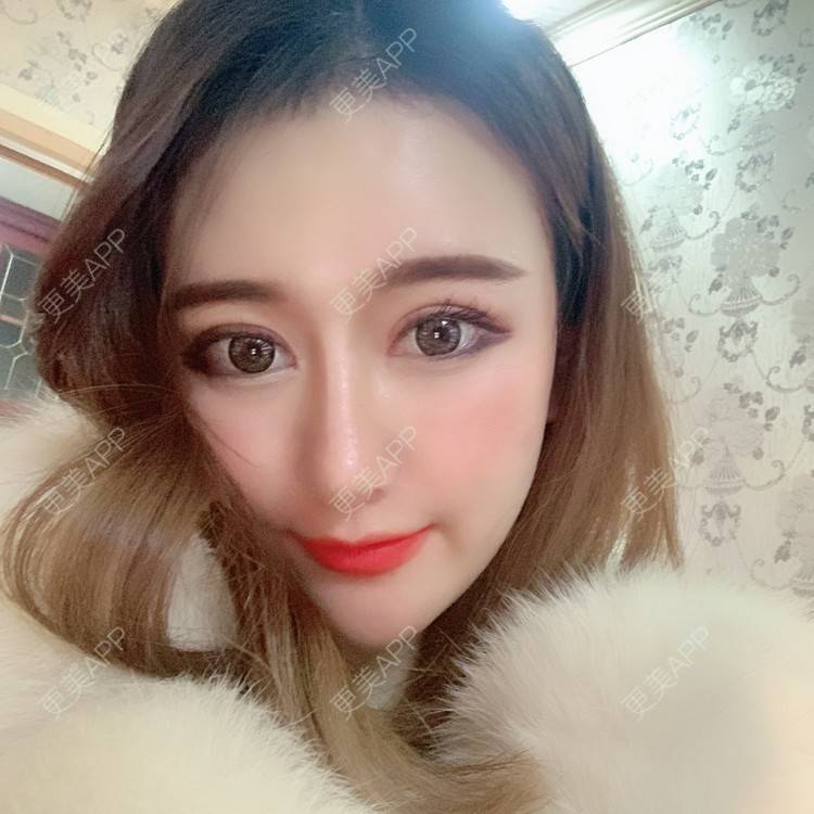 更美 - 火锅最爱小丸子的全切双眼皮经验 | 视频日记 | 全切双眼皮 | 重庆 | 开内眼角 | 定点双眼皮 | 开眼角修复 | 双眼皮修复