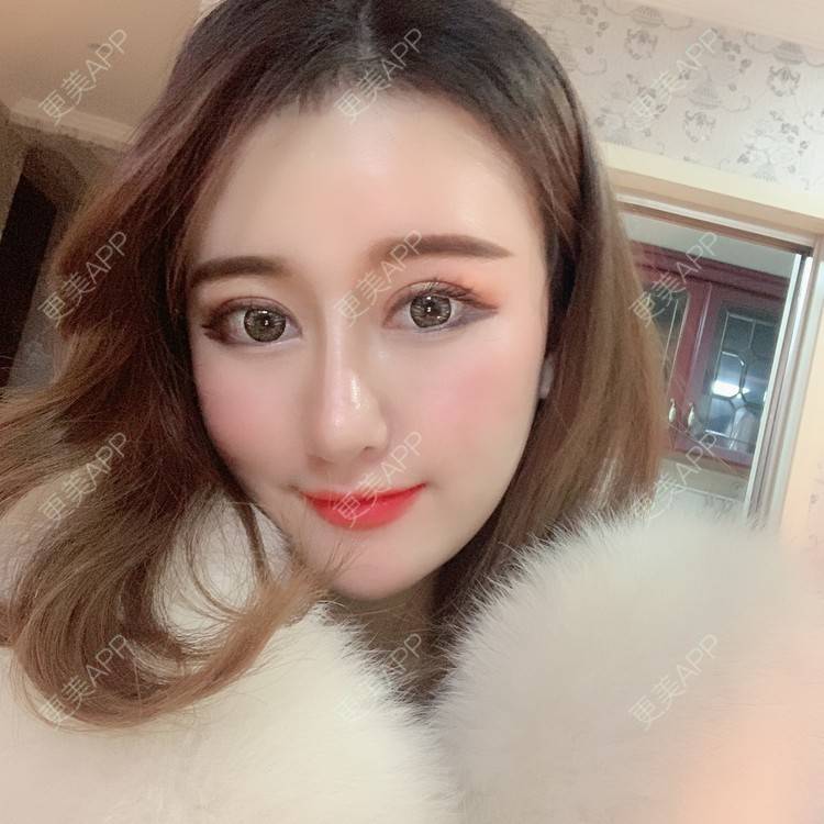 更美 - 火锅最爱小丸子的全切双眼皮经验 | 视频日记 | 全切双眼皮 | 重庆 | 开内眼角 | 定点双眼皮 | 开眼角修复 | 双眼皮修复