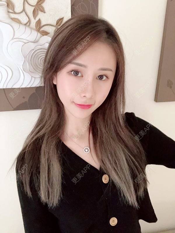 更美 - 七彩百香柠檬茶的鼻部多项经验 | 鼻小柱延长 | 自体软骨垫鼻尖 | 鼻部多项 | 硅胶隆鼻 | 肋软骨隆鼻 | 重庆 | 鼻翼缩小