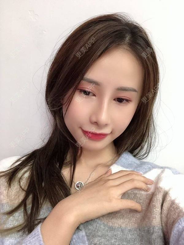 更美 - 七彩百香柠檬茶的鼻部多项经验 | 鼻小柱延长 | 自体软骨垫鼻尖 | 鼻部多项 | 硅胶隆鼻 | 肋软骨隆鼻 | 重庆 | 鼻翼缩小