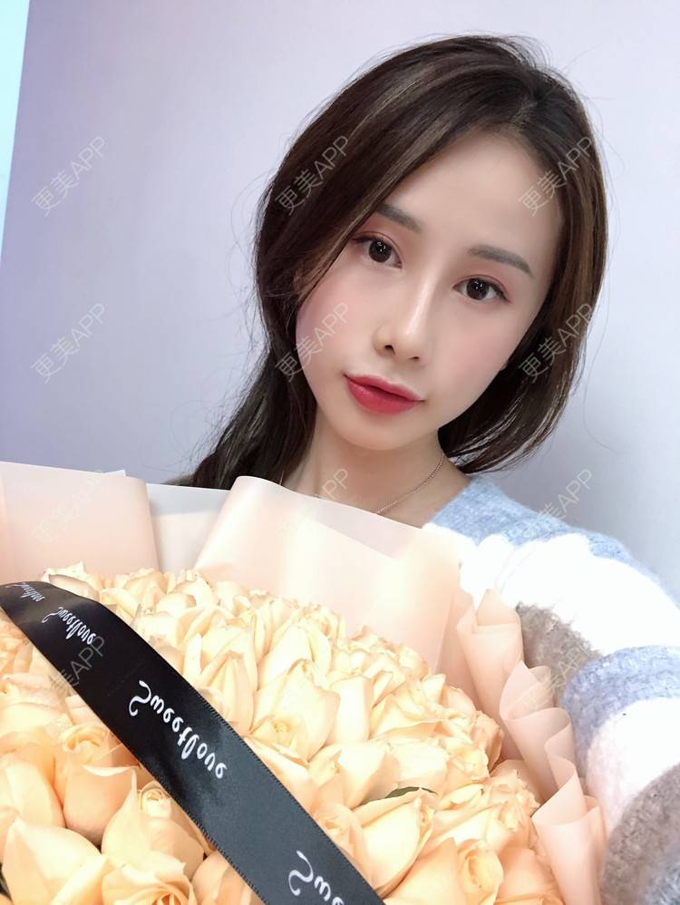 更美 - 七彩百香柠檬茶的鼻部多项经验 | 鼻小柱延长 | 自体软骨垫鼻尖 | 鼻部多项 | 硅胶隆鼻 | 肋软骨隆鼻 | 重庆 | 鼻翼缩小