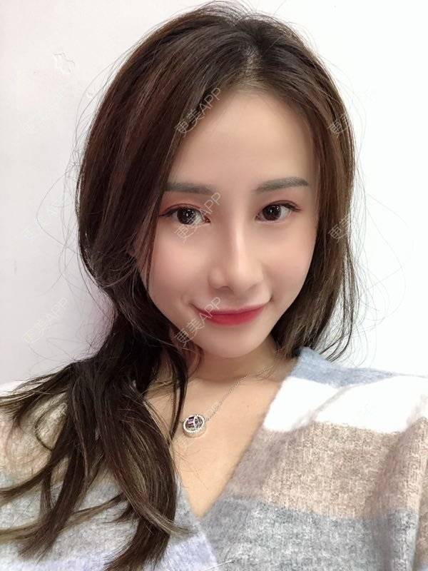 更美 - 七彩百香柠檬茶的鼻部多项经验 | 鼻小柱延长 | 自体软骨垫鼻尖 | 鼻部多项 | 硅胶隆鼻 | 肋软骨隆鼻 | 重庆 | 鼻翼缩小