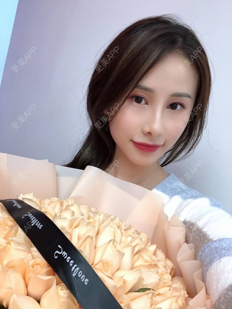 更美 - 七彩百香柠檬茶的鼻部多项经验 | 鼻小柱延长 | 自体软骨垫鼻尖 | 鼻部多项 | 硅胶隆鼻 | 肋软骨隆鼻 | 重庆 | 鼻翼缩小