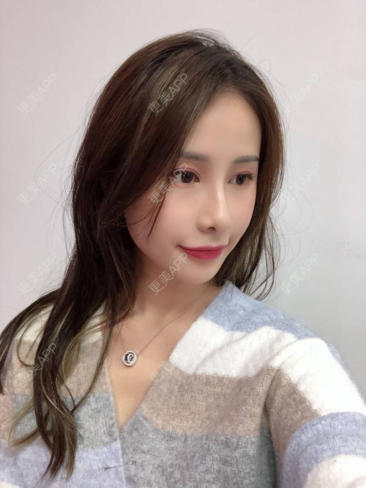 更美 - 七彩百香柠檬茶的鼻部多项经验 | 鼻小柱延长 | 自体软骨垫鼻尖 | 鼻部多项 | 硅胶隆鼻 | 肋软骨隆鼻 | 重庆 | 鼻翼缩小