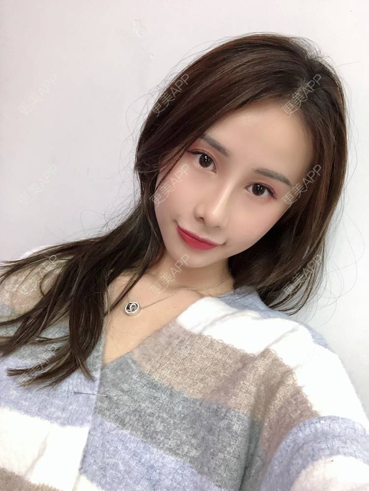 更美 - 七彩百香柠檬茶的鼻部多项经验 | 鼻小柱延长 | 自体软骨垫鼻尖 | 鼻部多项 | 硅胶隆鼻 | 肋软骨隆鼻 | 重庆 | 鼻翼缩小