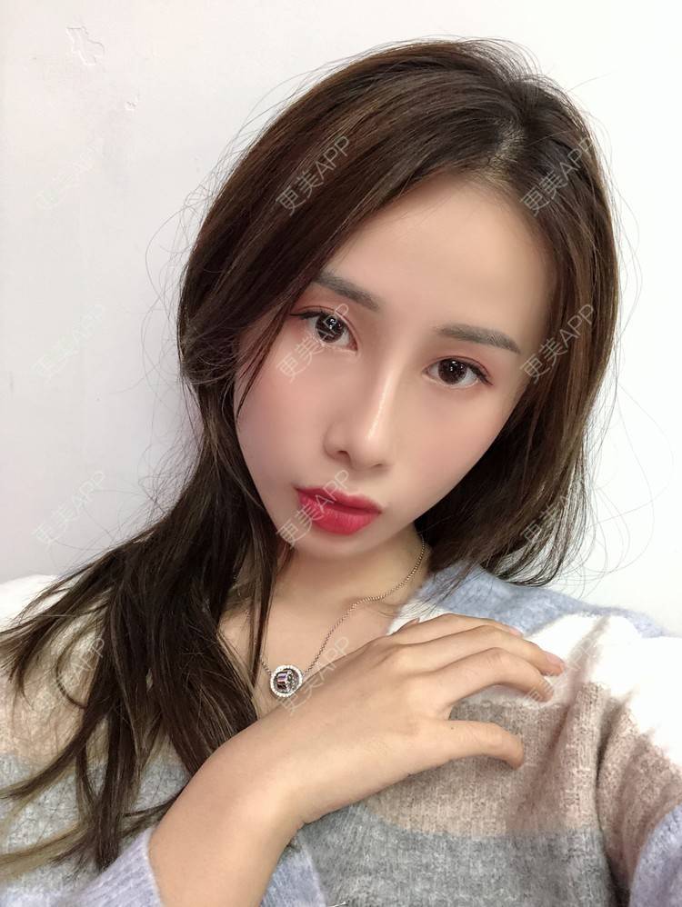 更美 - 七彩百香柠檬茶的鼻部多项经验 | 鼻小柱延长 | 自体软骨垫鼻尖 | 鼻部多项 | 硅胶隆鼻 | 肋软骨隆鼻 | 重庆 | 鼻翼缩小