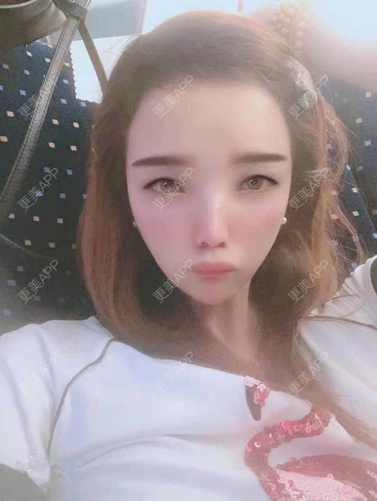更美 - 更美用户EWqDuvHmIb的自体脂肪丰面颊经验 | 自体脂肪丰面颊 | 成都