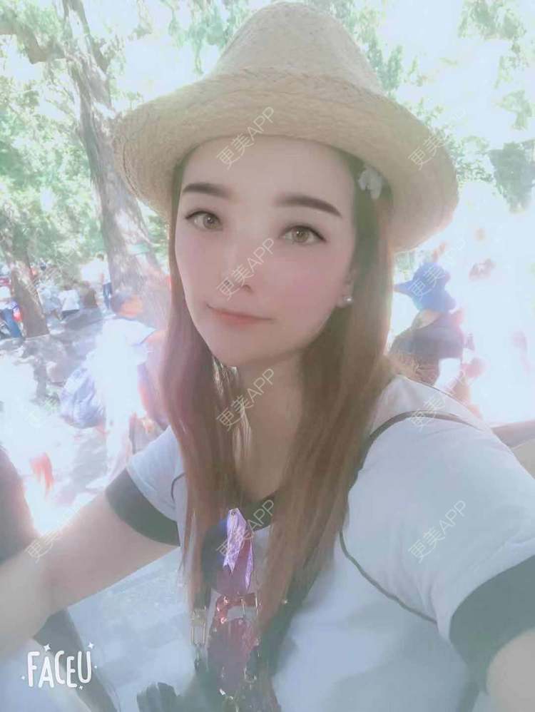 更美 - 更美用户EWqDuvHmIb的自体脂肪丰面颊经验 | 自体脂肪丰面颊 | 成都