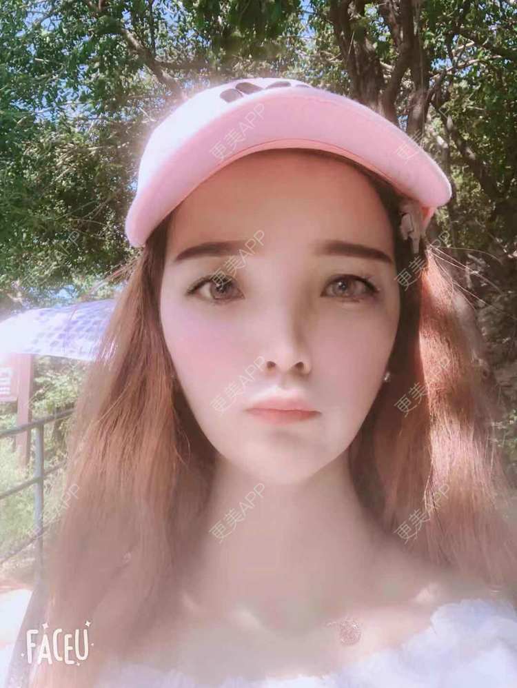 更美 - 更美用户EWqDuvHmIb的自体脂肪丰面颊经验 | 自体脂肪丰面颊 | 成都