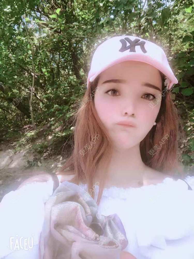 更美 - 更美用户EWqDuvHmIb的自体脂肪丰面颊经验 | 自体脂肪丰面颊 | 成都