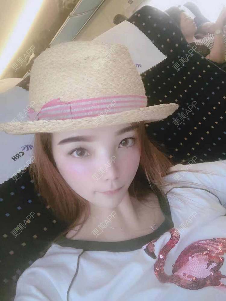 更美 - 更美用户EWqDuvHmIb的自体脂肪丰面颊经验 | 自体脂肪丰面颊 | 成都