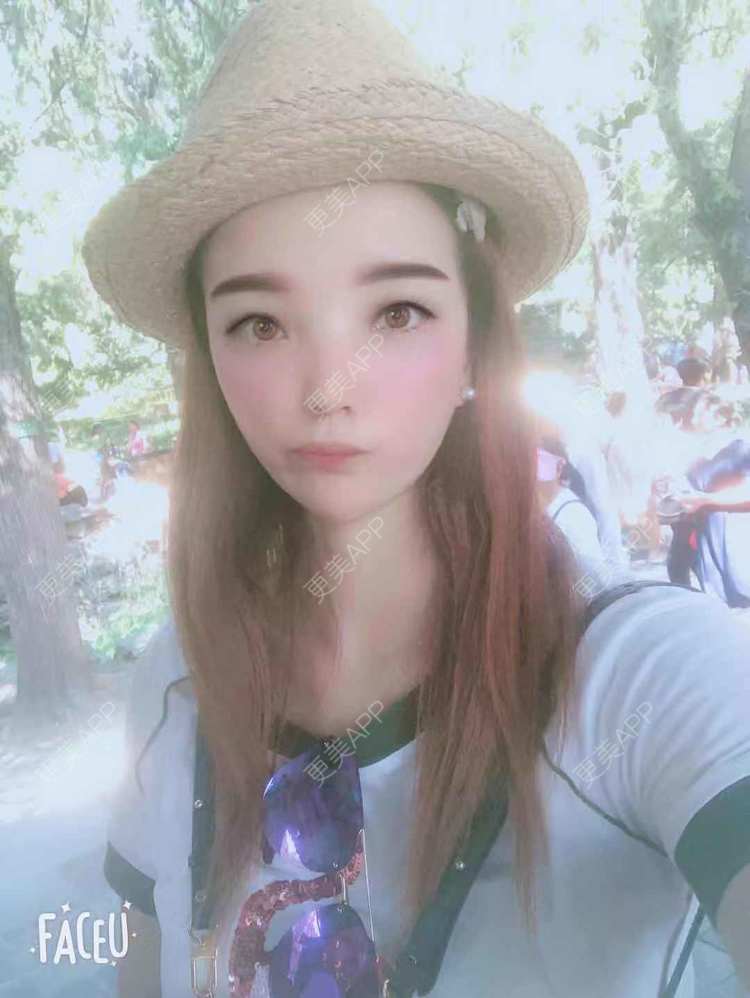 更美 - 更美用户EWqDuvHmIb的自体脂肪丰面颊经验 | 自体脂肪丰面颊 | 成都