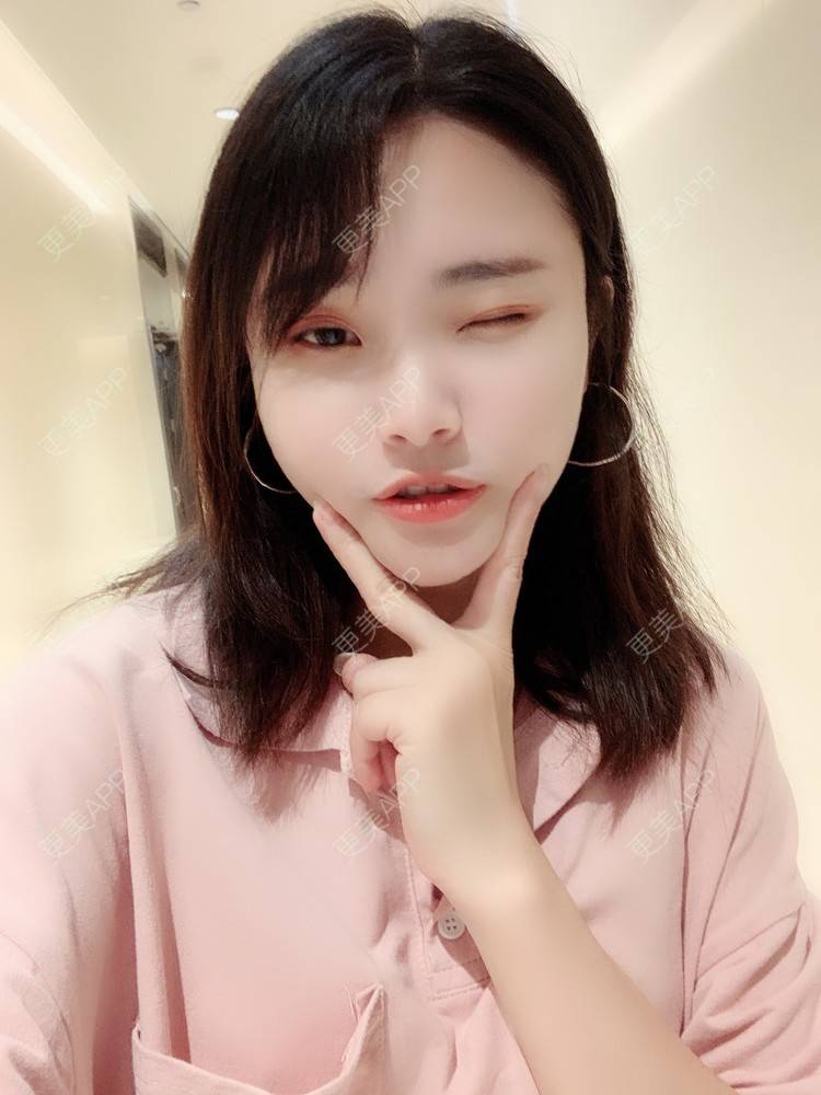 更美 - 大美人图的自体脂肪丰额头经验 | 更美研究所 | 自体脂肪丰额头 | 杭州