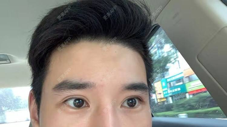 更美 - 狂风里的拥抱栋的胶原蛋白丰泪沟经验 | 胶原蛋白丰泪沟 | 杭州