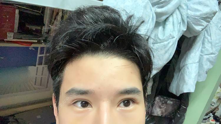 更美 - 狂风里的拥抱栋的胶原蛋白丰泪沟经验 | 胶原蛋白丰泪沟 | 杭州