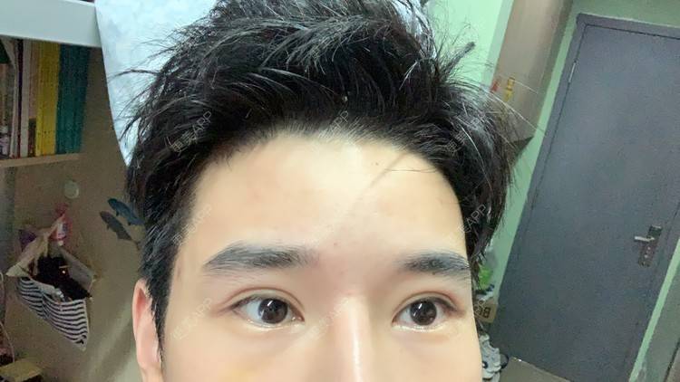 更美 - 狂风里的拥抱栋的胶原蛋白丰泪沟经验 | 胶原蛋白丰泪沟 | 杭州