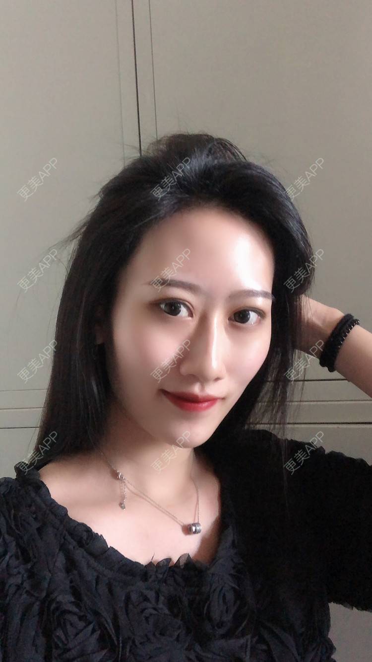 更美 - 更美用户dzhtMneR9R的全切双眼皮经验 | 全切双眼皮 | 开内眼角 | 玻尿酸卧蚕 | 提眉修复 | 眼部多项
