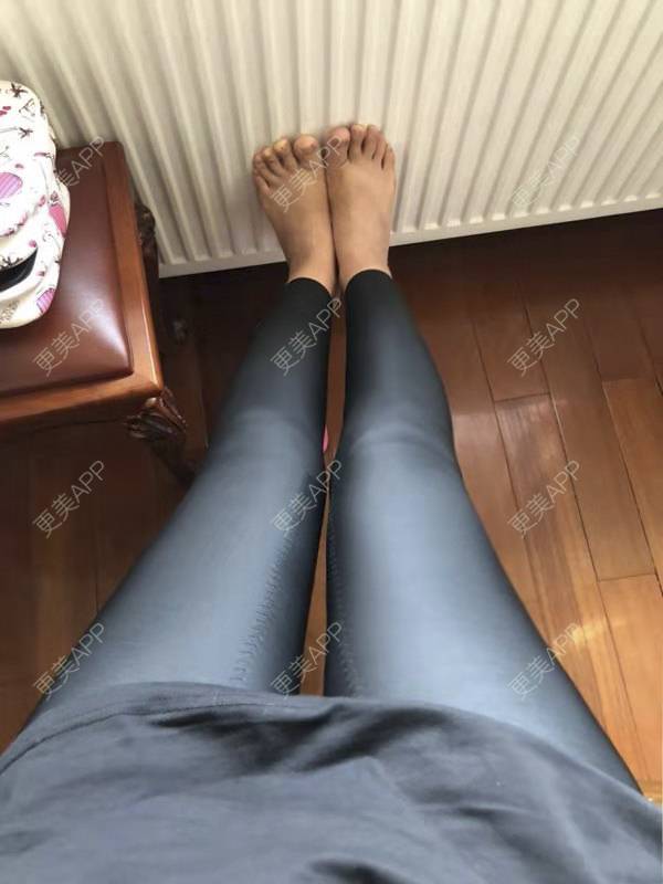 更美用户pncmjf9b6m的吸脂瘦大腿日记