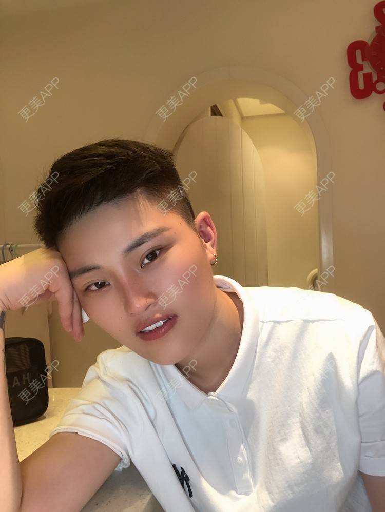 更美 - 更美用户jElE6LuBhW的厚唇改薄经验 | 厚唇改薄 | 微笑唇手术 | M唇成形 | 成都