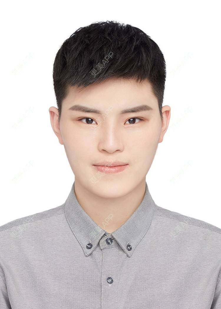 更美 - 更美用户jElE6LuBhW的厚唇改薄经验 | 厚唇改薄 | 成都 | M唇成形 | 微笑唇手术