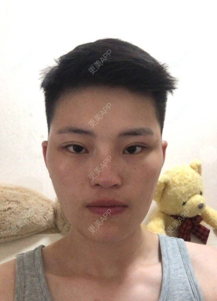 更美 - 更美用户jElE6LuBhW的厚唇改薄经验 | 厚唇改薄 | 成都 | M唇成形 | 微笑唇手术