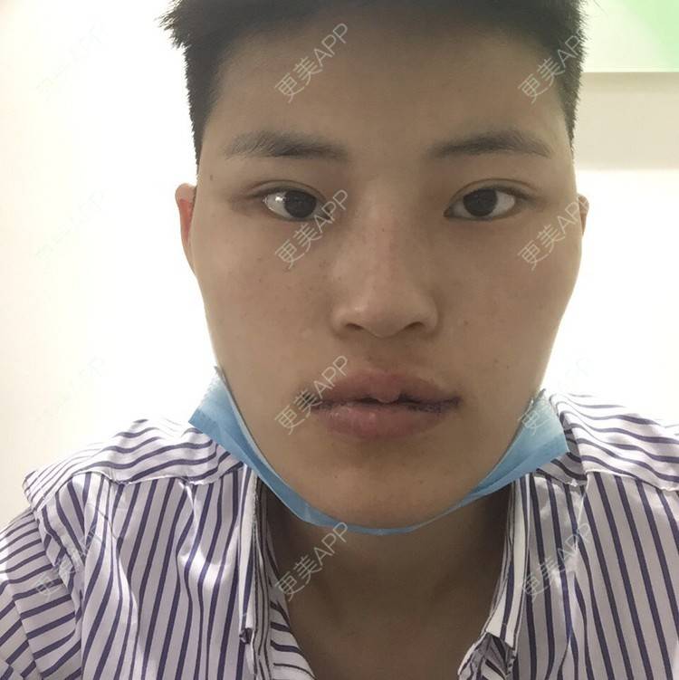 更美 - 更美用户jElE6LuBhW的厚唇改薄经验 | M唇成形 | 厚唇改薄 | 成都 | 微笑唇手术