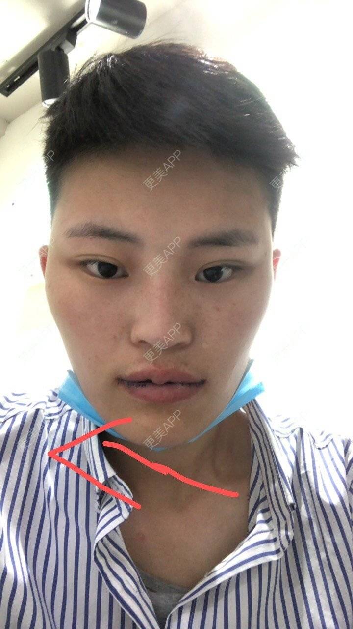 更美 - 更美用户jElE6LuBhW的厚唇改薄经验 | M唇成形 | 厚唇改薄 | 成都 | 微笑唇手术