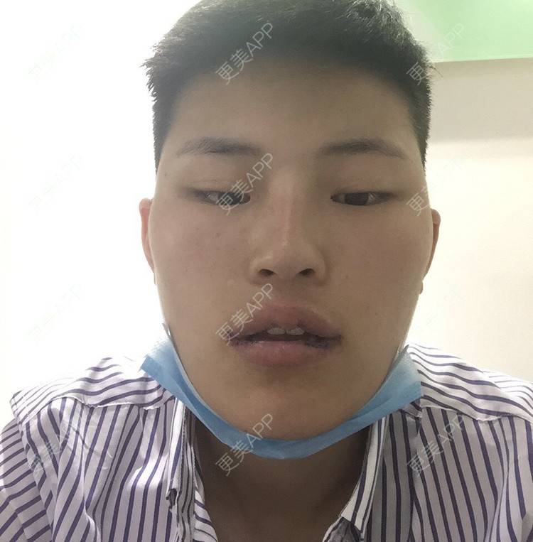 更美 - 更美用户jElE6LuBhW的厚唇改薄经验 | M唇成形 | 厚唇改薄 | 成都 | 微笑唇手术