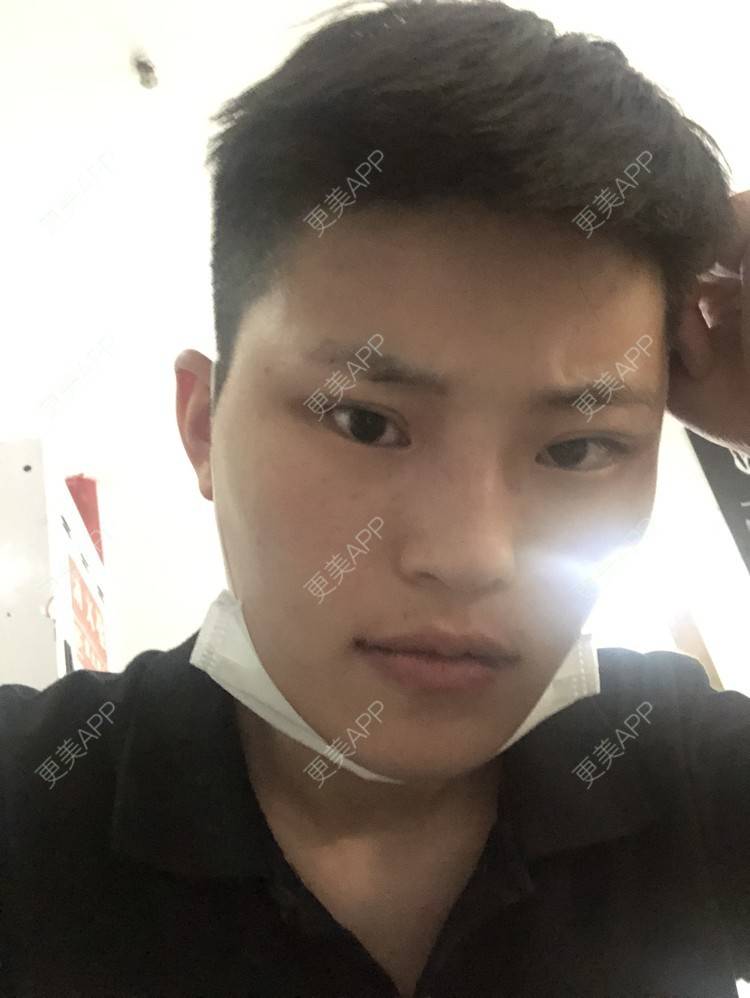 更美 - 更美用户jElE6LuBhW的厚唇改薄经验 | 厚唇改薄 | 成都 | M唇成形 | 微笑唇手术