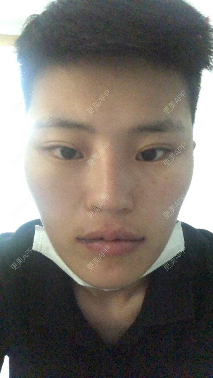 更美 - 更美用户jElE6LuBhW的厚唇改薄经验 | 厚唇改薄 | 成都 | M唇成形 | 微笑唇手术