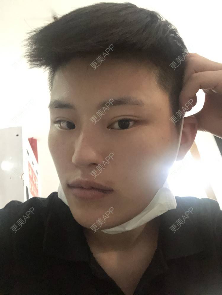 更美 - 更美用户jElE6LuBhW的厚唇改薄经验 | 厚唇改薄 | 成都 | M唇成形 | 微笑唇手术