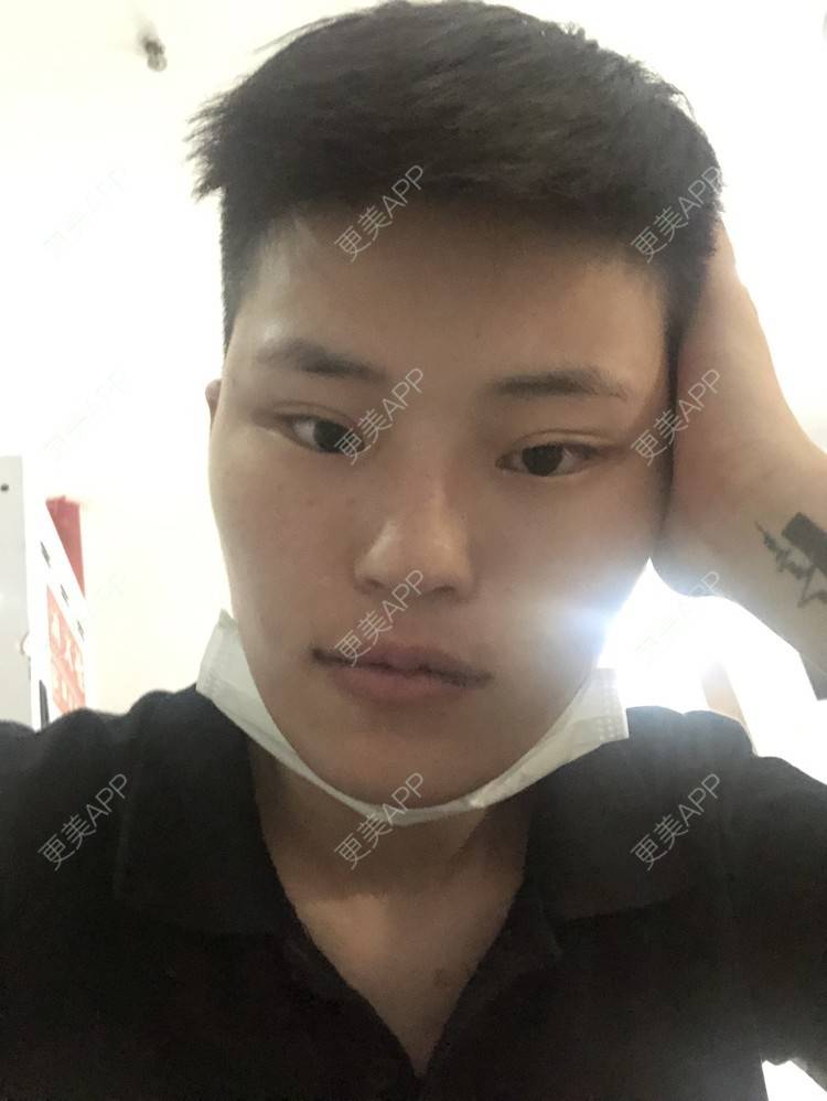 更美 - 更美用户jElE6LuBhW的厚唇改薄经验 | 厚唇改薄 | 成都 | M唇成形 | 微笑唇手术