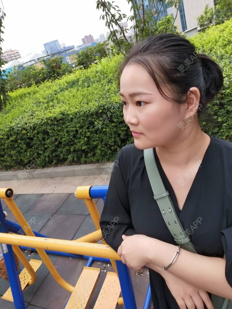更美 - 花花cd的隆鼻经验 | 隆鼻 | 膨体隆鼻 | 鼻中隔软骨隆鼻 | 鼻孔矫正 | 鼻部多项 | 郑州