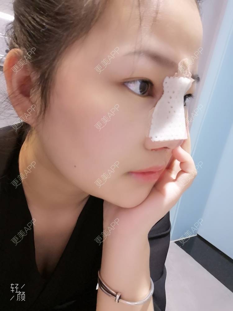 更美 - 花花cd的隆鼻经验 | 隆鼻 | 膨体隆鼻 | 鼻中隔软骨隆鼻 | 鼻孔矫正 | 鼻部多项 | 郑州