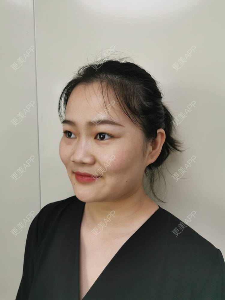 更美 - 花花cd的隆鼻经验 | 隆鼻 | 膨体隆鼻 | 鼻中隔软骨隆鼻 | 鼻孔矫正 | 鼻部多项 | 郑州
