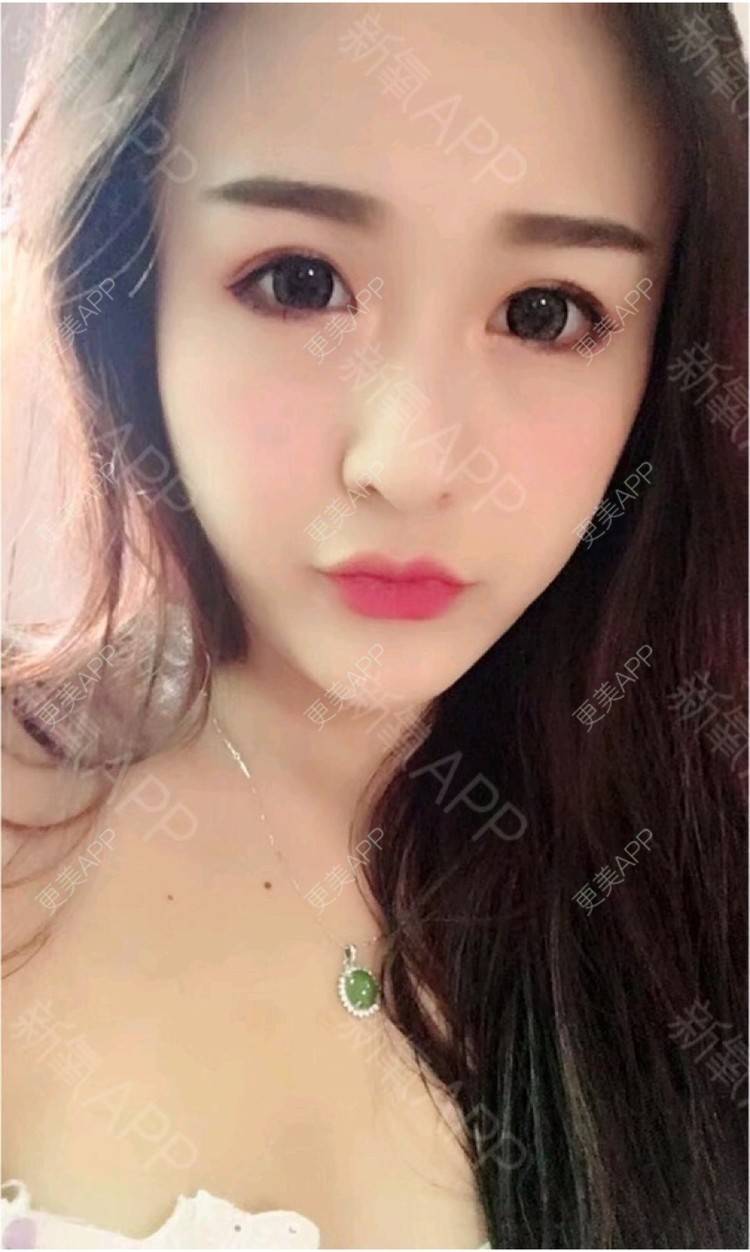 更美 - 更美用户9uaHVM3y2z的厚唇改薄经验 | 厚唇改薄 | 深圳