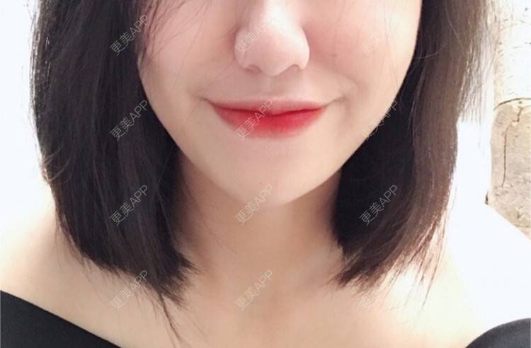 更美 - 更美用户Ey9IGQqgfh的厚唇改薄经验 | 厚唇改薄 | 深圳