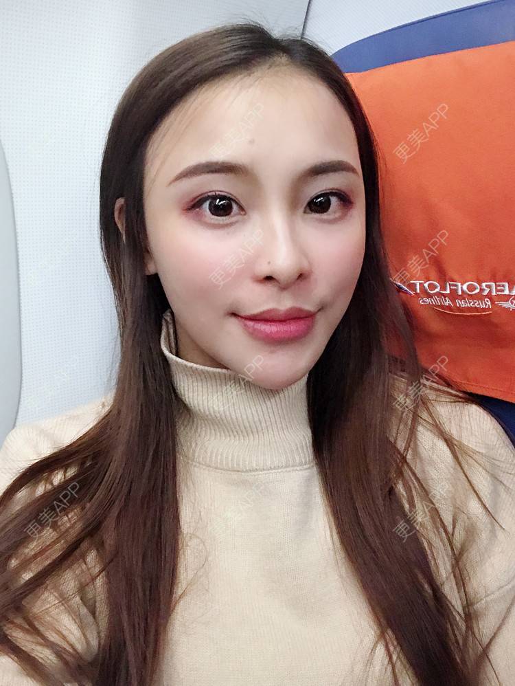 迷鹿m的玻尿酸下巴日记