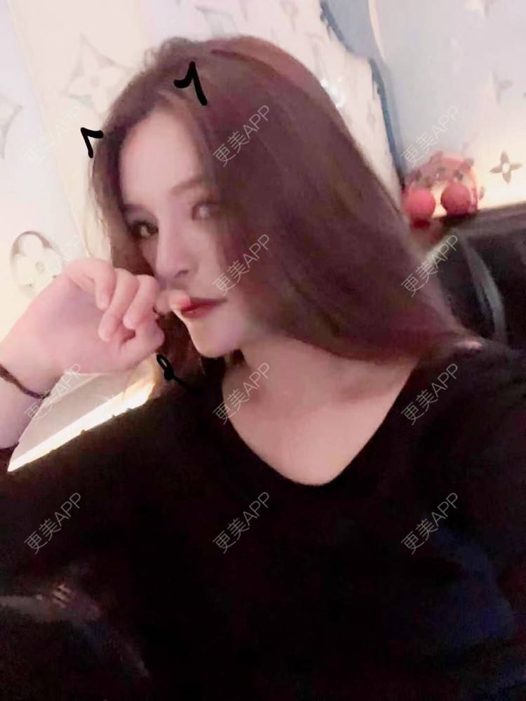 更美 - 依依若有情状的隆鼻经验 | 鼻部多项 | 鼻中隔软骨垫鼻头 | 自体软骨垫鼻尖 | 鼻小柱缩短 | 手术缩鼻头 | 自体脂肪隆鼻 | 肋软骨隆鼻 | 人工骨隆鼻 | 真皮隆鼻 | 微晶瓷隆鼻 | 全脸整形套餐
