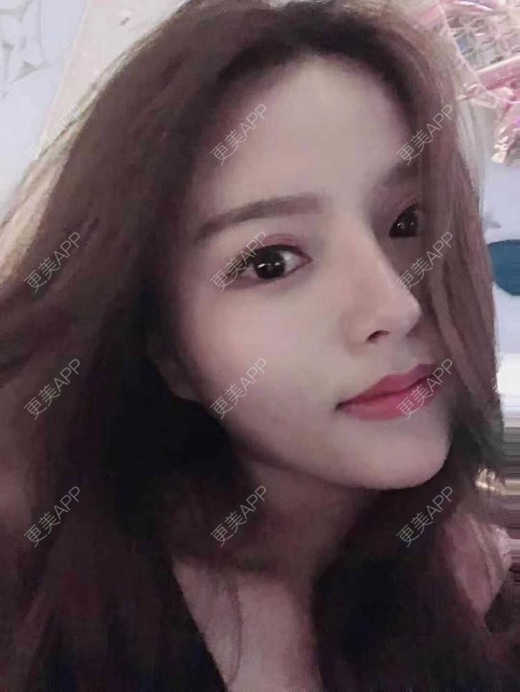 更美 - 依依若有情状的隆鼻经验 | 鼻部多项 | 鼻中隔软骨垫鼻头 | 自体软骨垫鼻尖 | 鼻小柱缩短 | 手术缩鼻头 | 自体脂肪隆鼻 | 肋软骨隆鼻 | 人工骨隆鼻 | 真皮隆鼻 | 微晶瓷隆鼻 | 全脸整形套餐