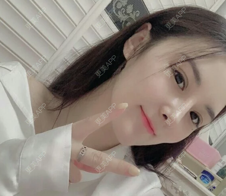 更美 - 更美用户JHAggu3OXV的真皮隆鼻经验 | 真皮隆鼻 | 杭州