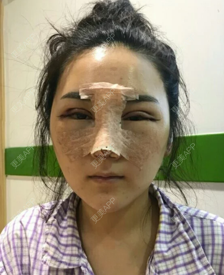 更美 - 更美用户JHAggu3OXV的真皮隆鼻经验 | 真皮隆鼻 | 杭州