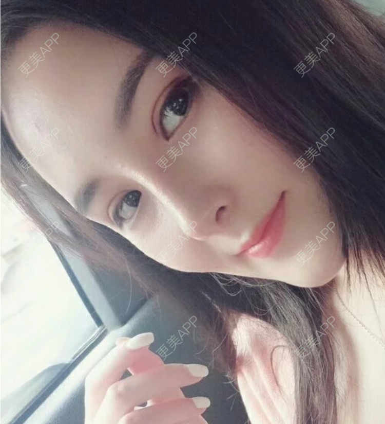更美 - 更美用户JHAggu3OXV的真皮隆鼻经验 | 真皮隆鼻 | 杭州