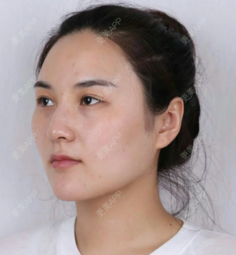 更美 - 更美用户JHAggu3OXV的真皮隆鼻经验 | 真皮隆鼻 | 杭州