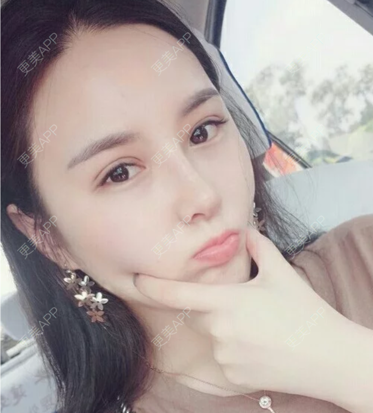 更美 - 更美用户JHAggu3OXV的真皮隆鼻经验 | 真皮隆鼻 | 杭州