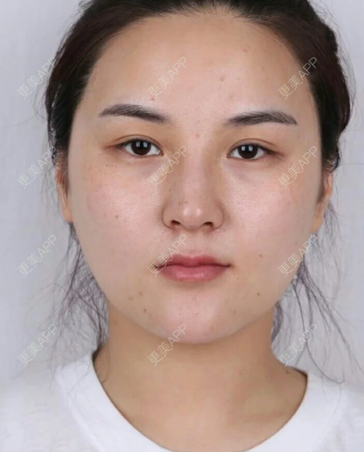 更美 - 更美用户JHAggu3OXV的真皮隆鼻经验 | 真皮隆鼻 | 杭州