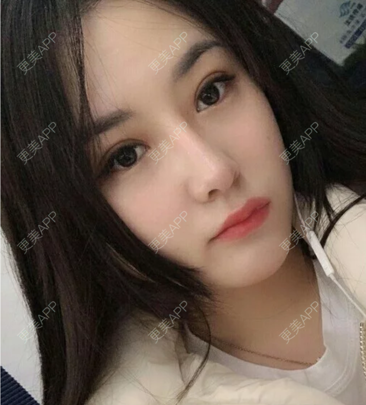 更美 - 更美用户JHAggu3OXV的真皮隆鼻经验 | 真皮隆鼻 | 杭州