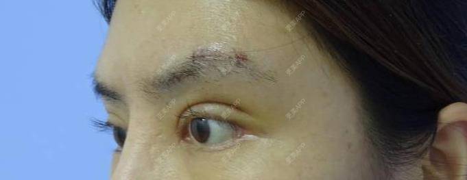 更美 - 更美用户t7ZLrifwYB的膨体垫眉弓经验 | 膨体垫眉弓 | 垫眉弓 | 硅胶垫眉弓 | 重庆